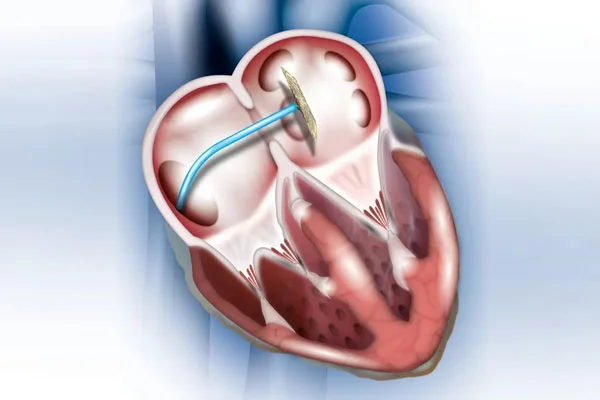 Device Closure of ASD or VSD or PDA