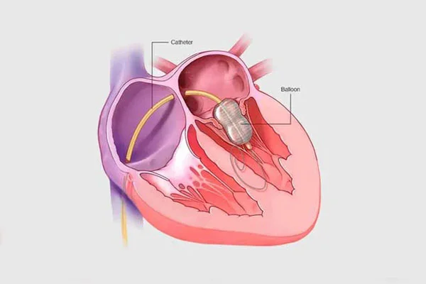 Percutaneous Balloon Mitral Valvuloplasty